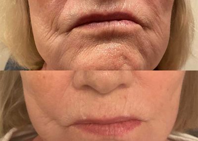 Before & After SkinVive