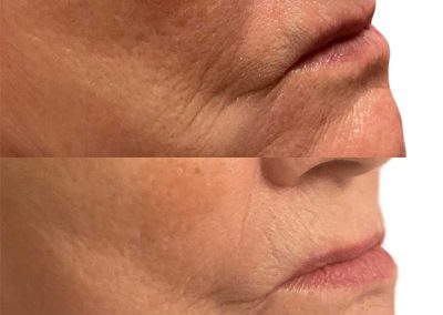 Before & After SkinVive