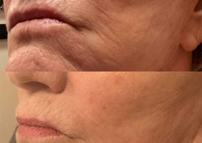 Before & After SkinVive