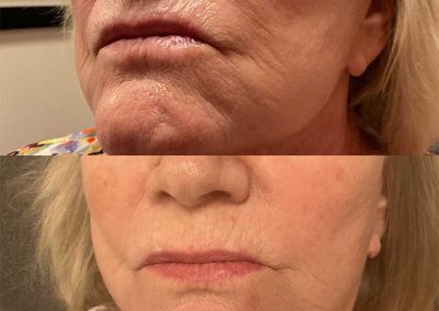 Before & After SkinVive