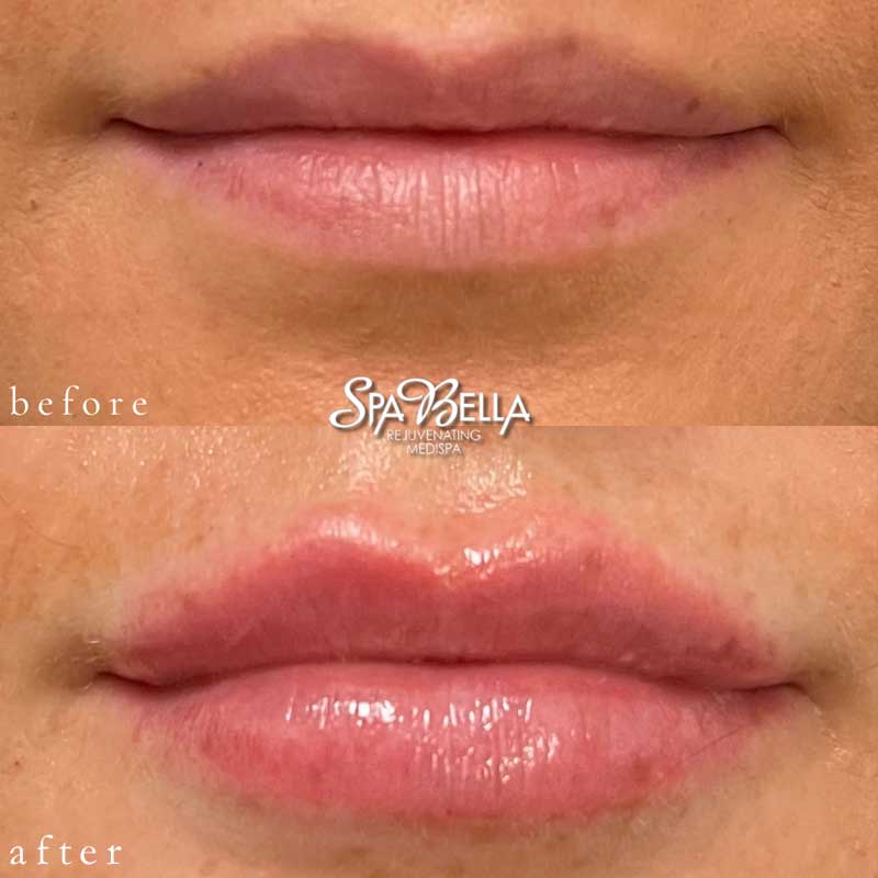 Before & After Lip Filler