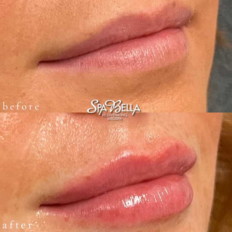 Before & After Lip Filler