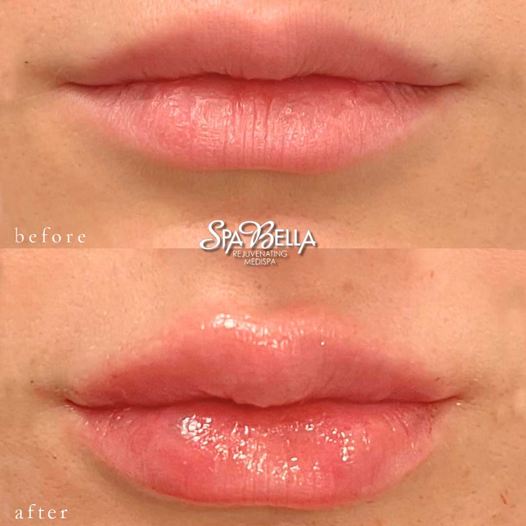 Lip Filler Before and After