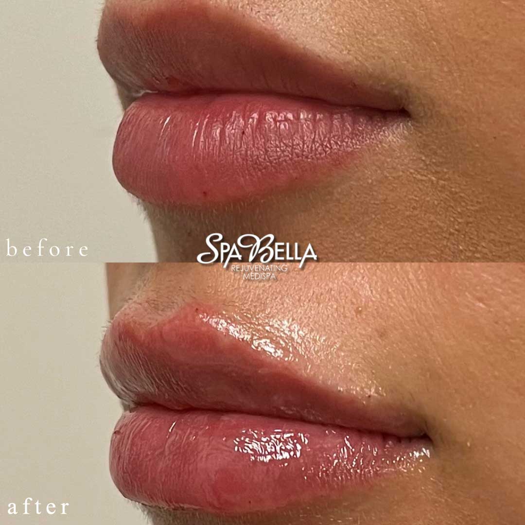 Lip Filler Before and After
