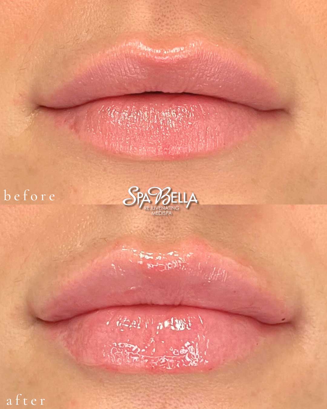 Lips - Before and After