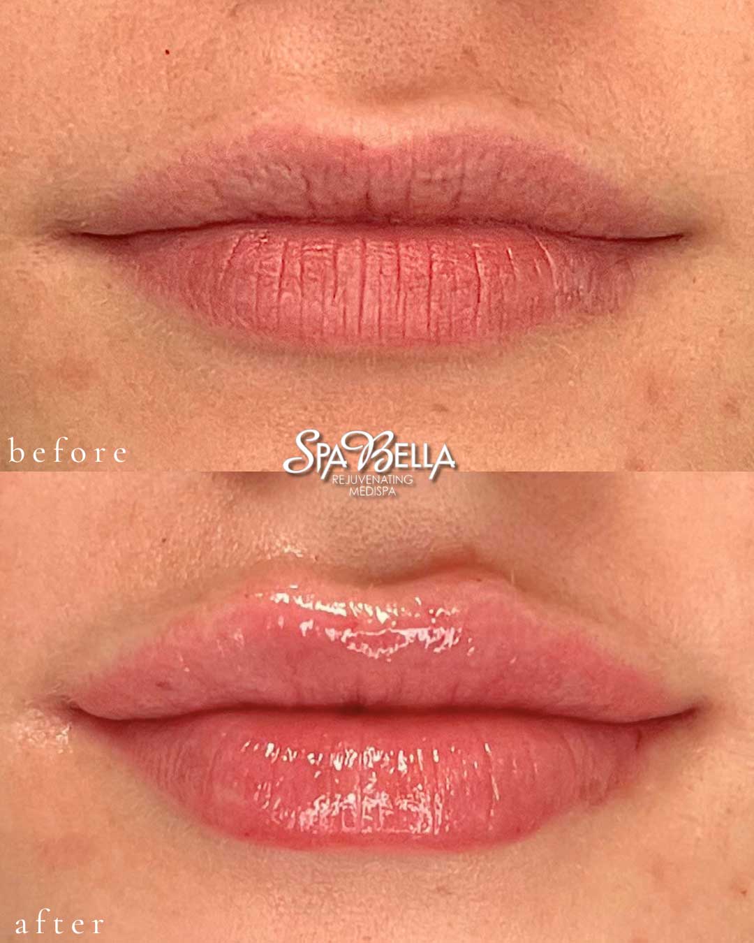 Lips - Before and After