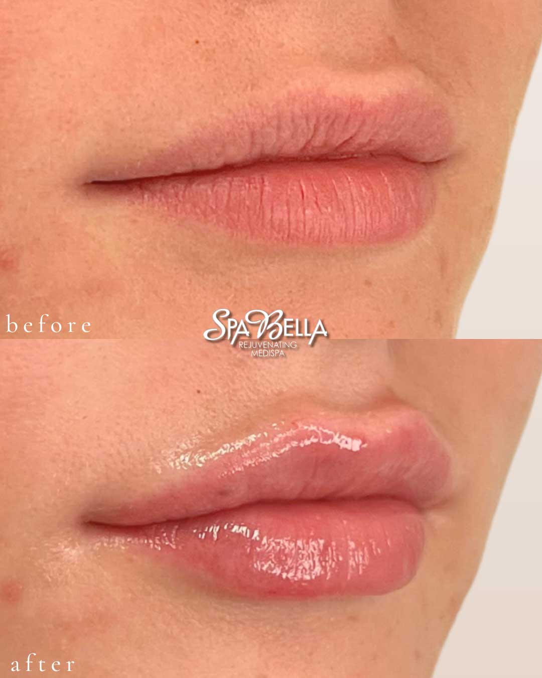 Lips - Before and After