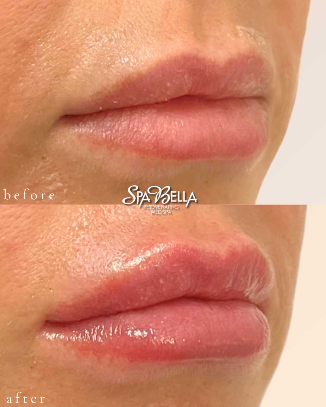 Lips - Before and After