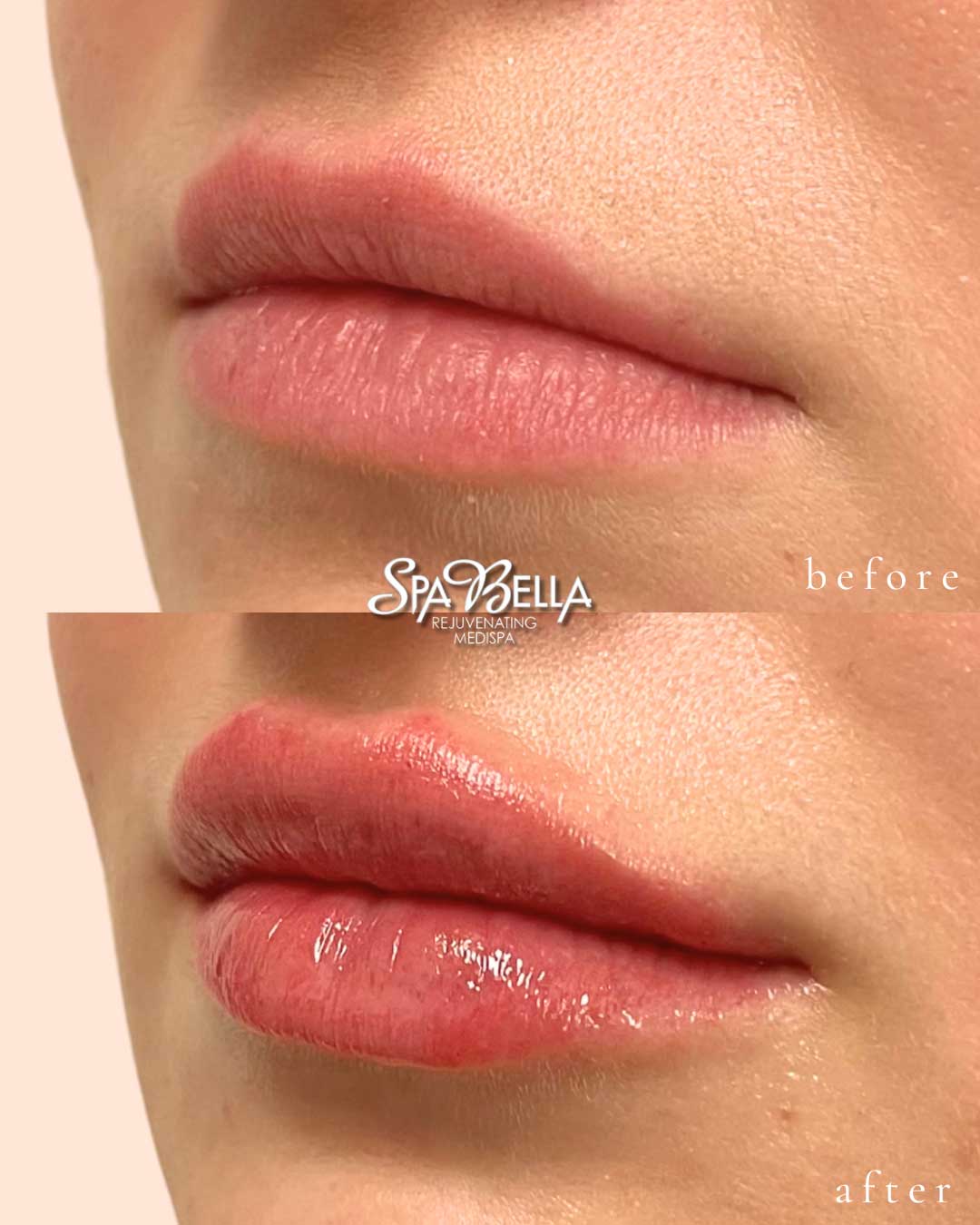 Lips - Before and After