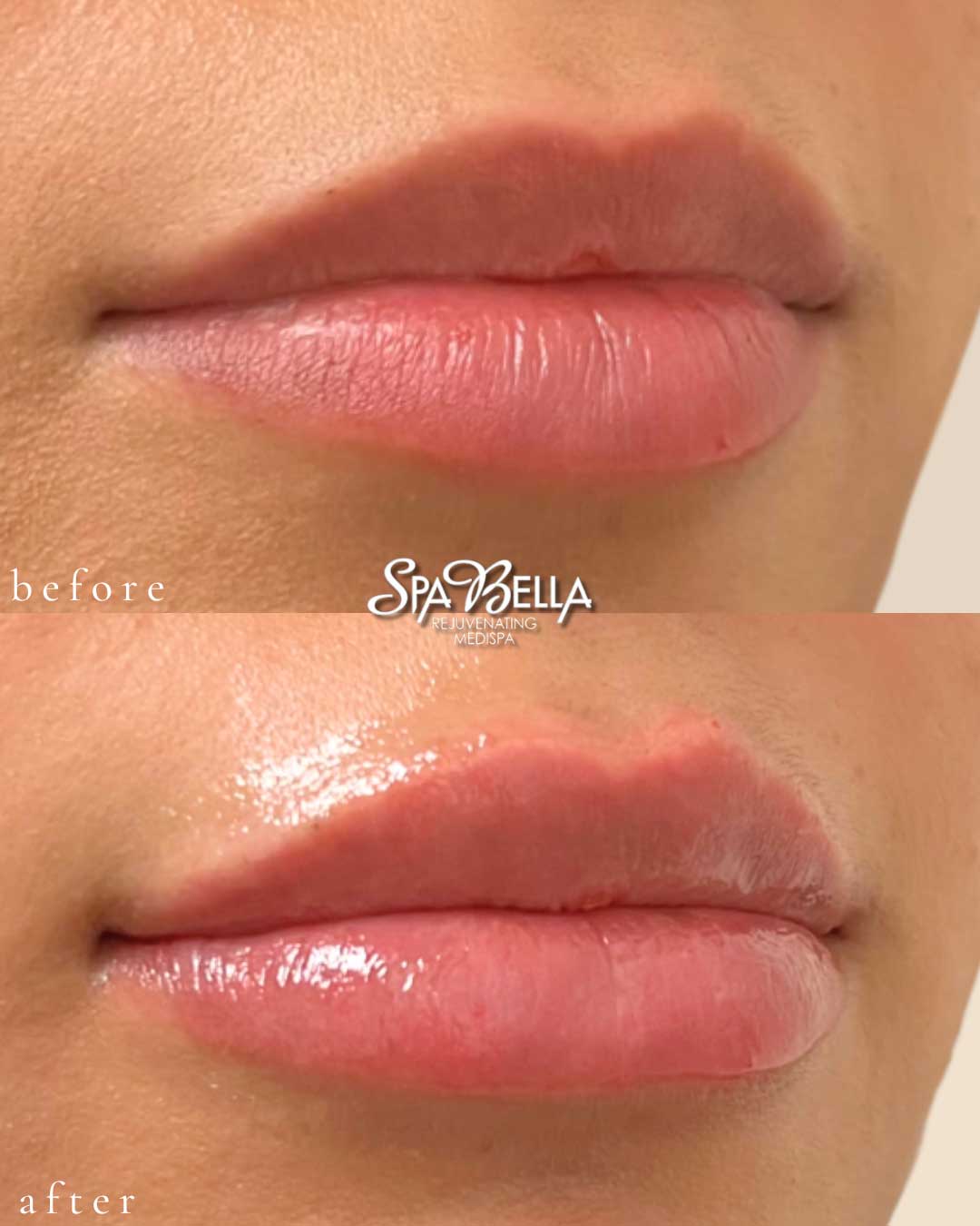 Lips - Before and After