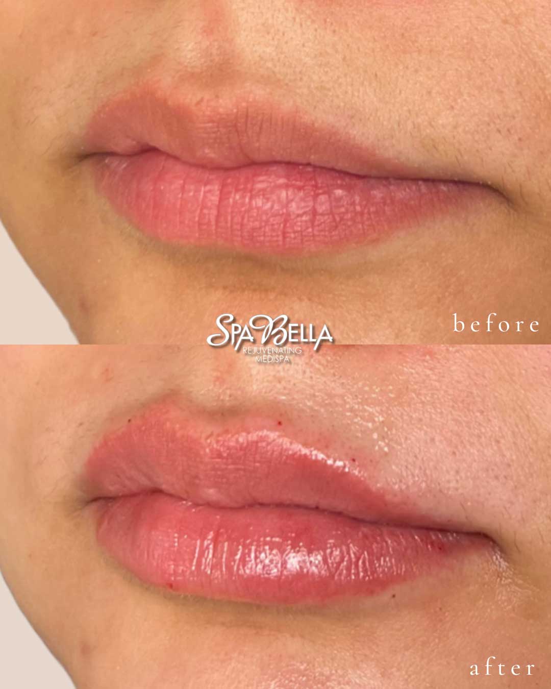 Lips - Before and After