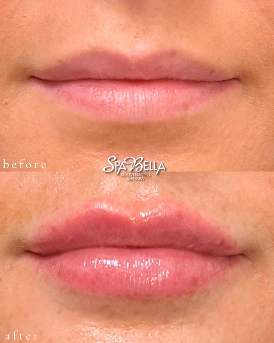 Lips - Before and After