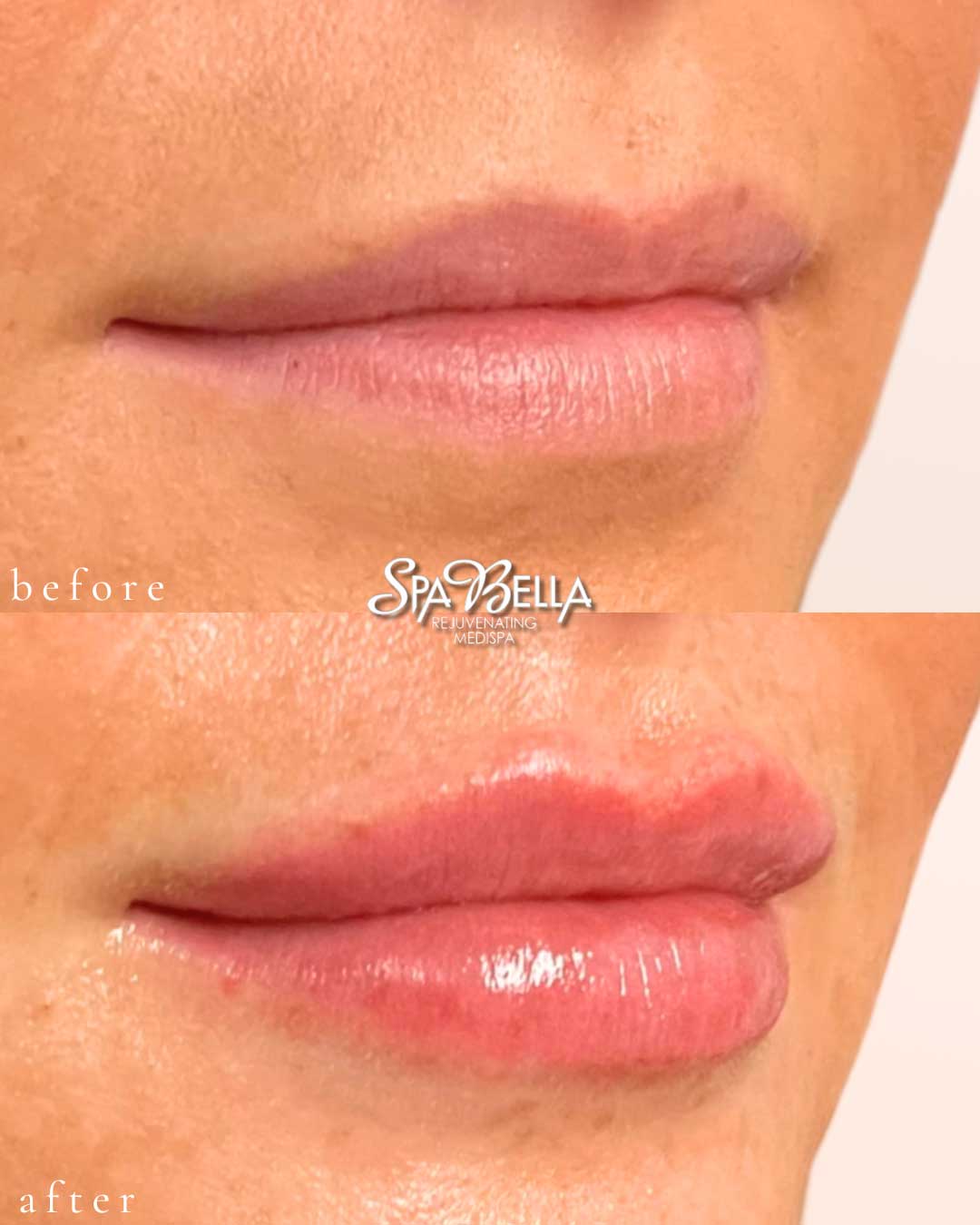 Lips - Before and After