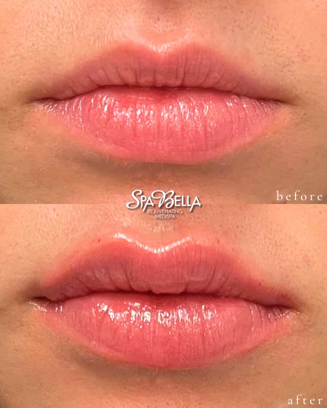 Lips - Before and After