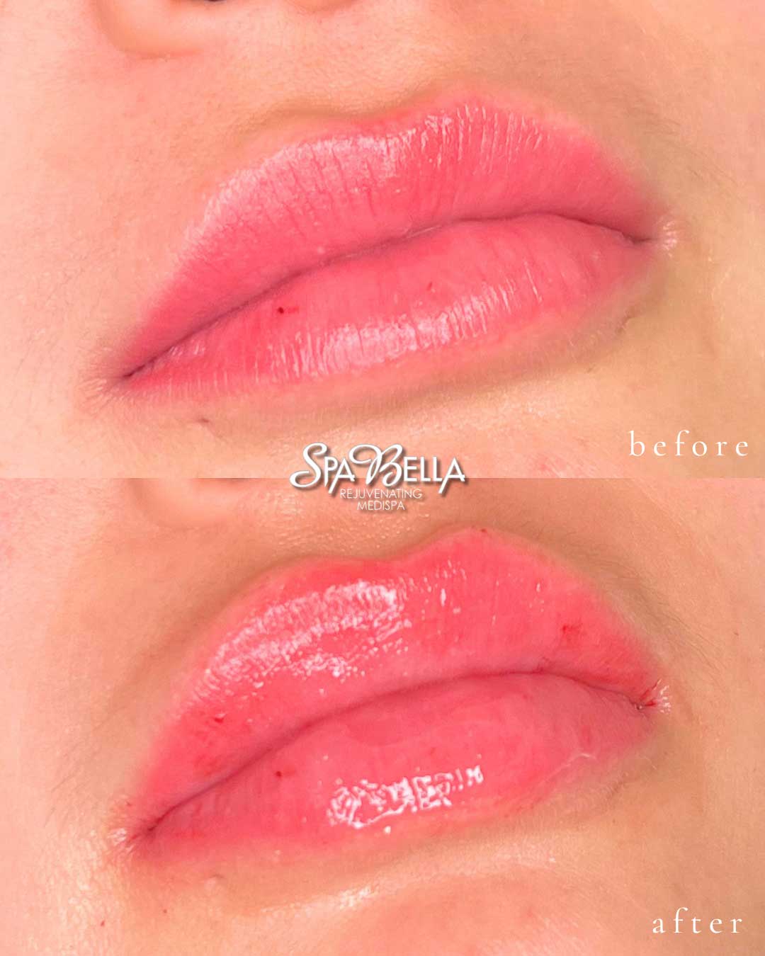 Lips - Before and After