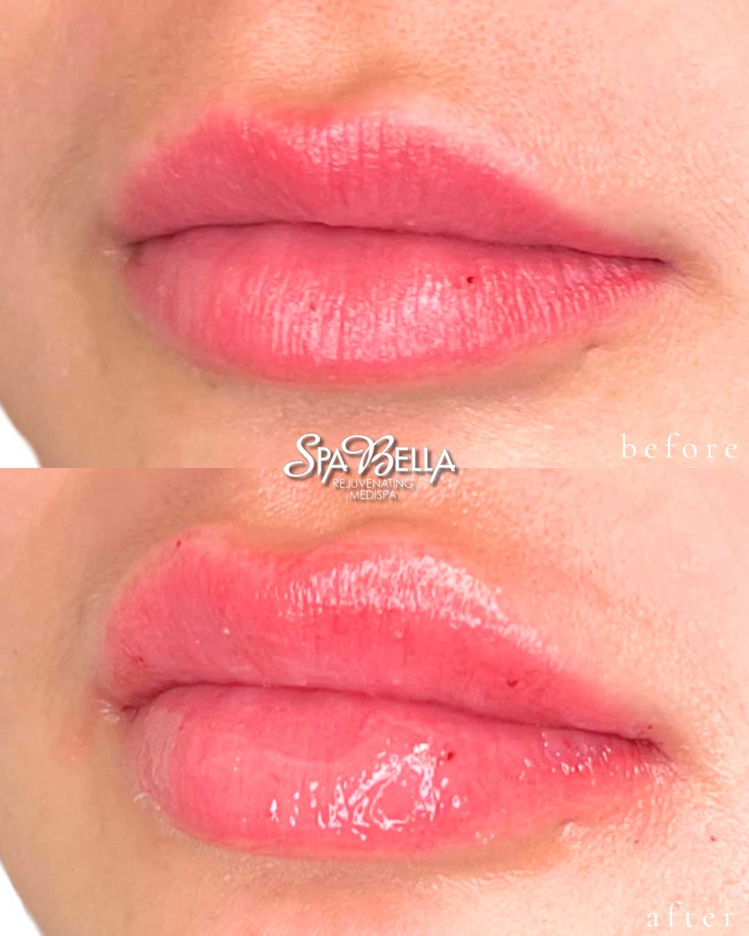 Lips - Before and After