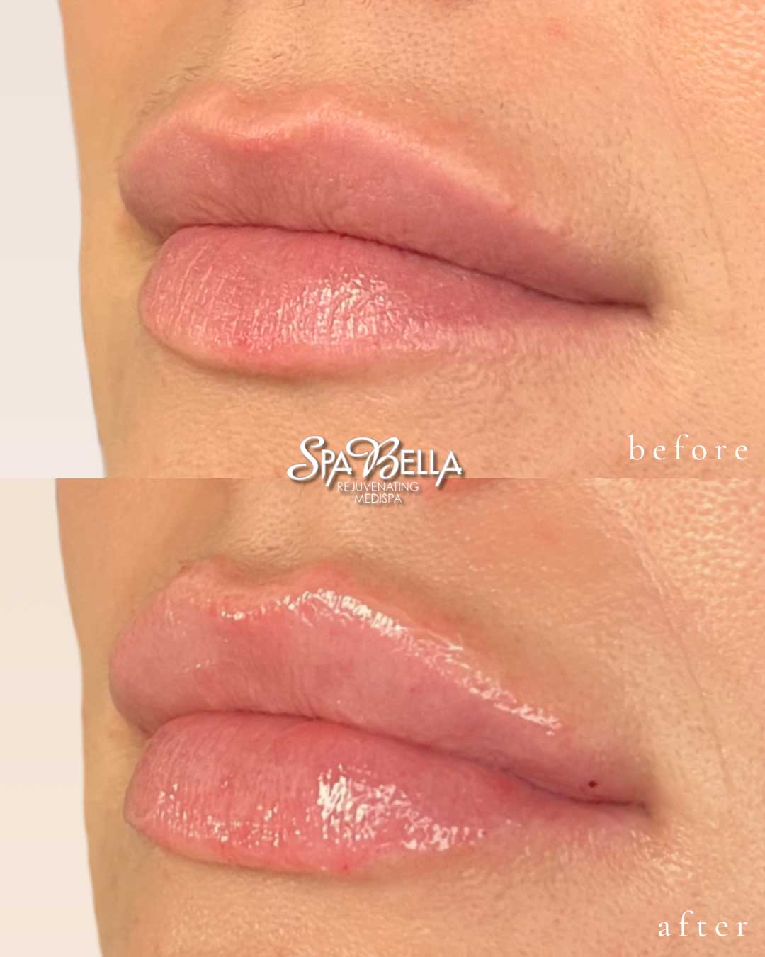 Lips - Before and After
