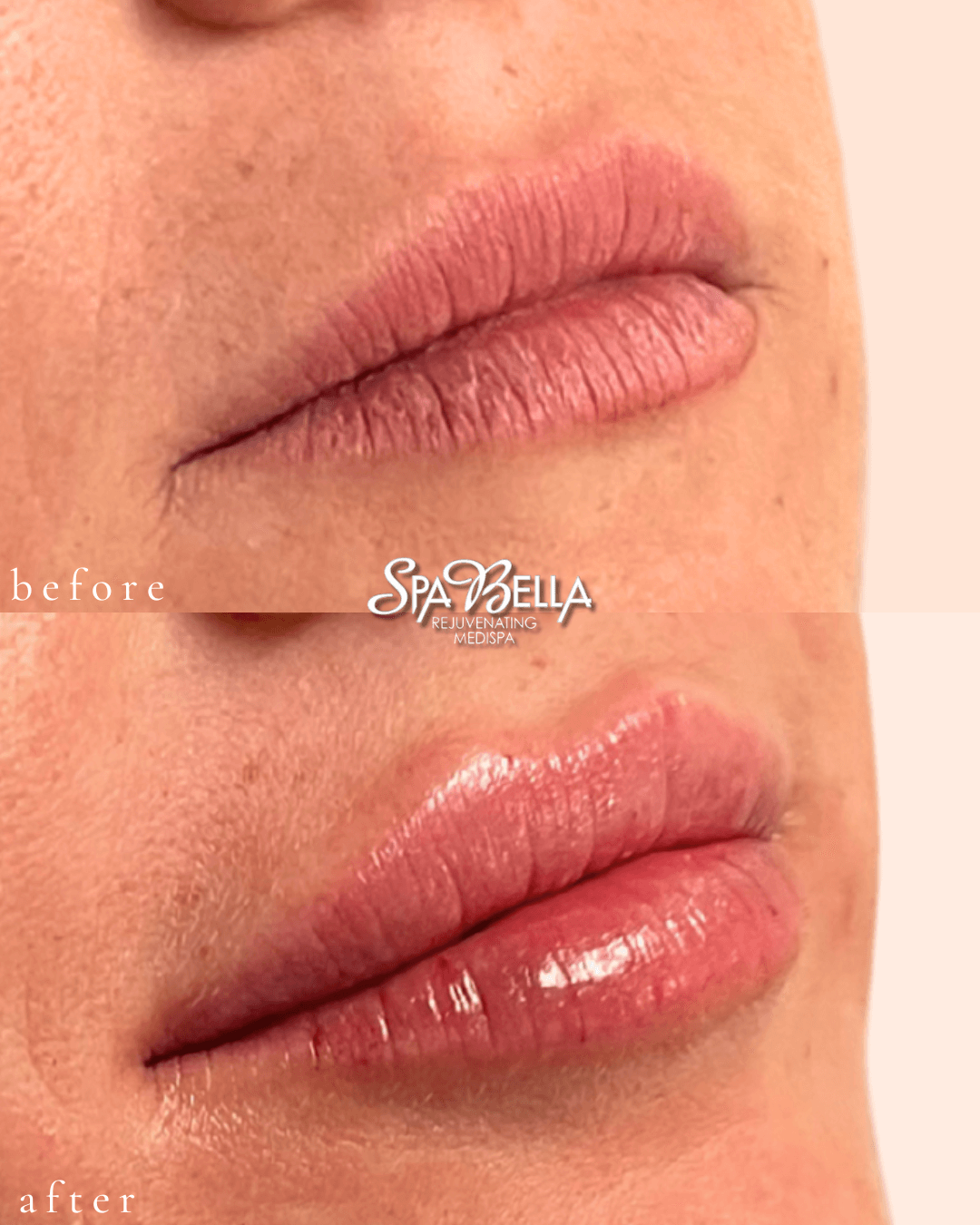 Lips - Before and After