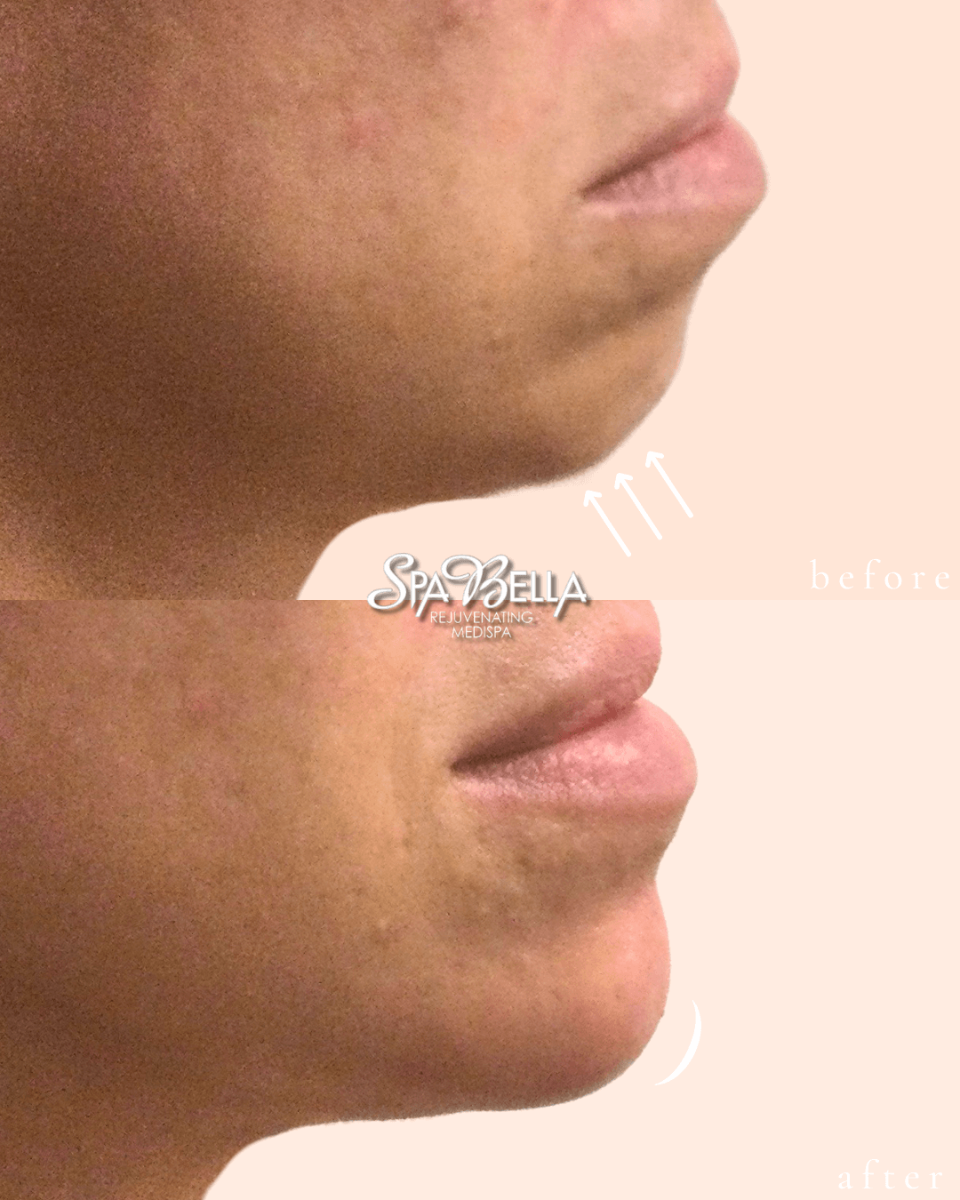 Chin Dimple and Nasolabial Fold Filler