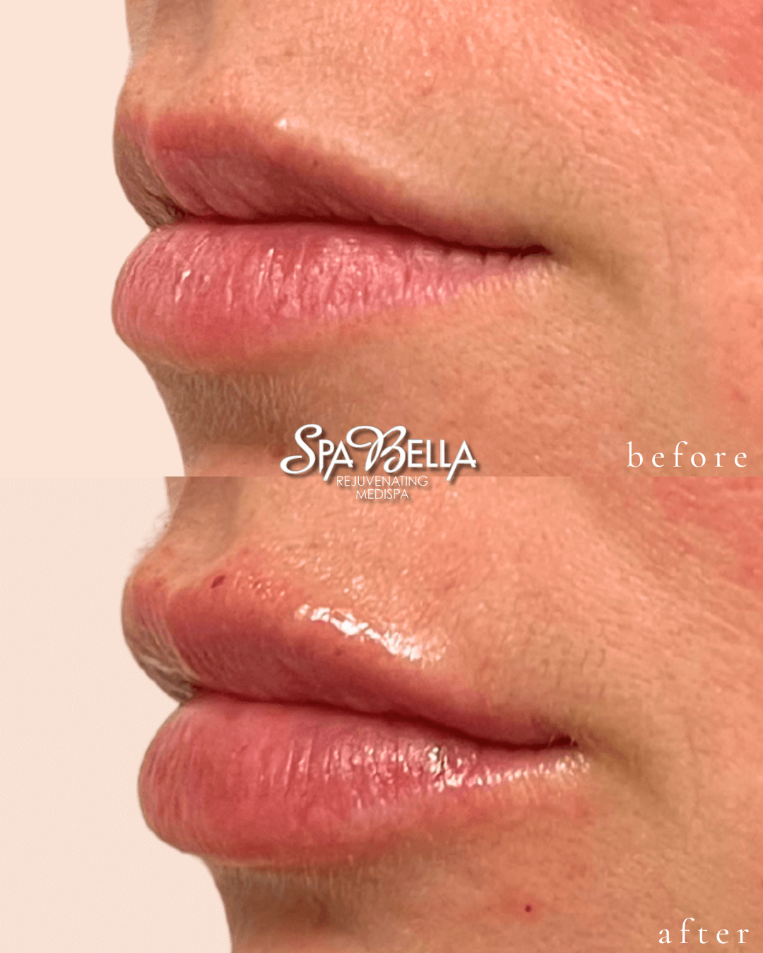 Lips - Before and After