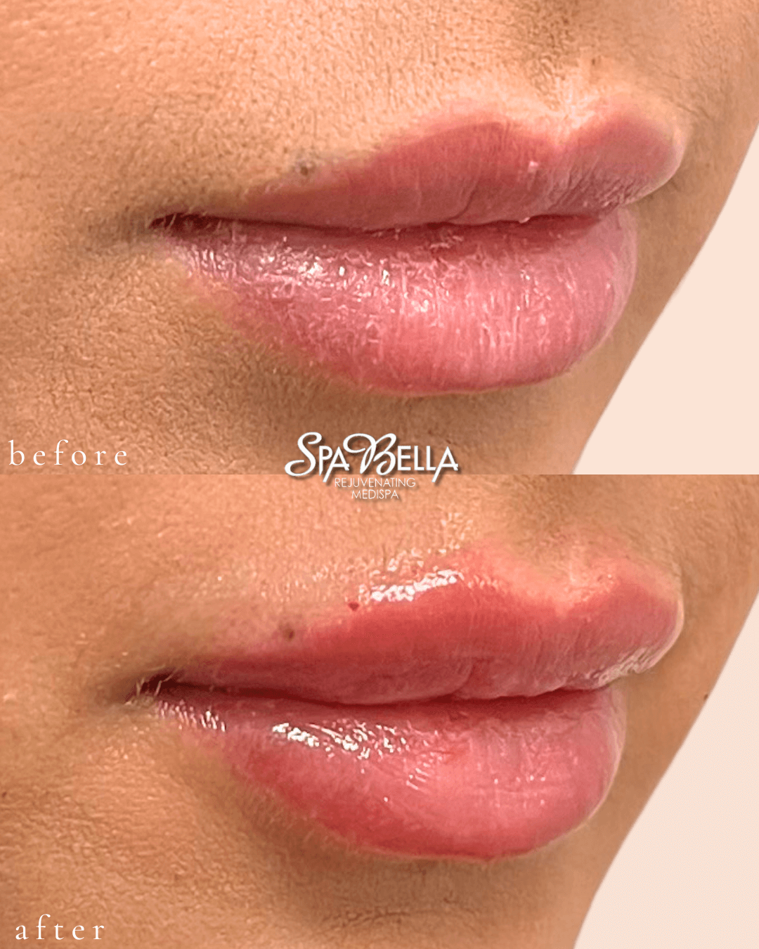 Lips - Before and After