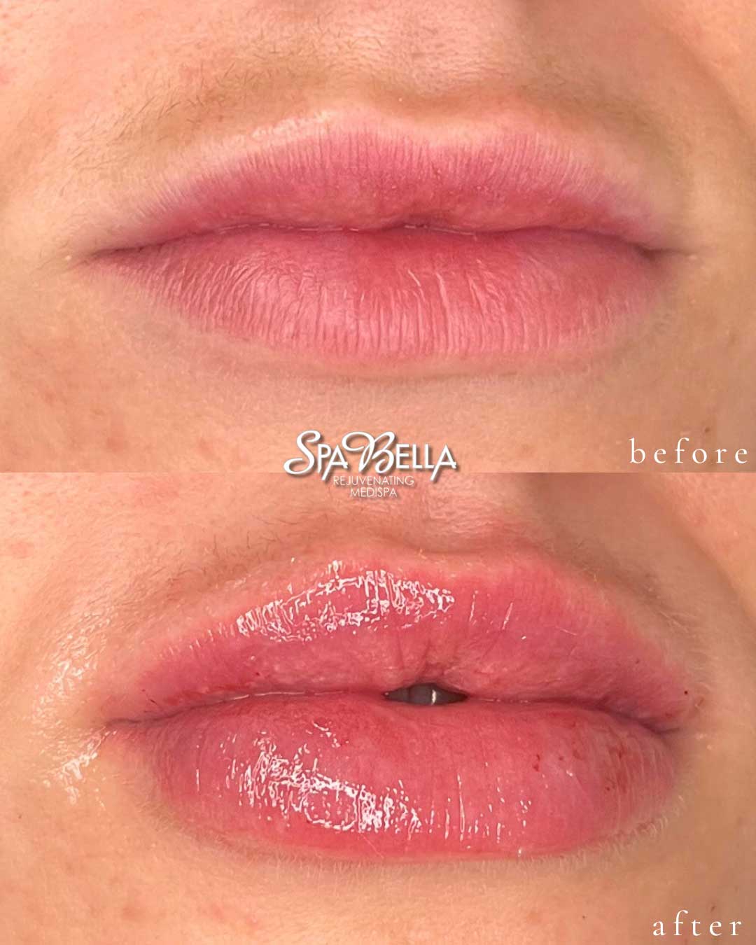 Lips - Before and After