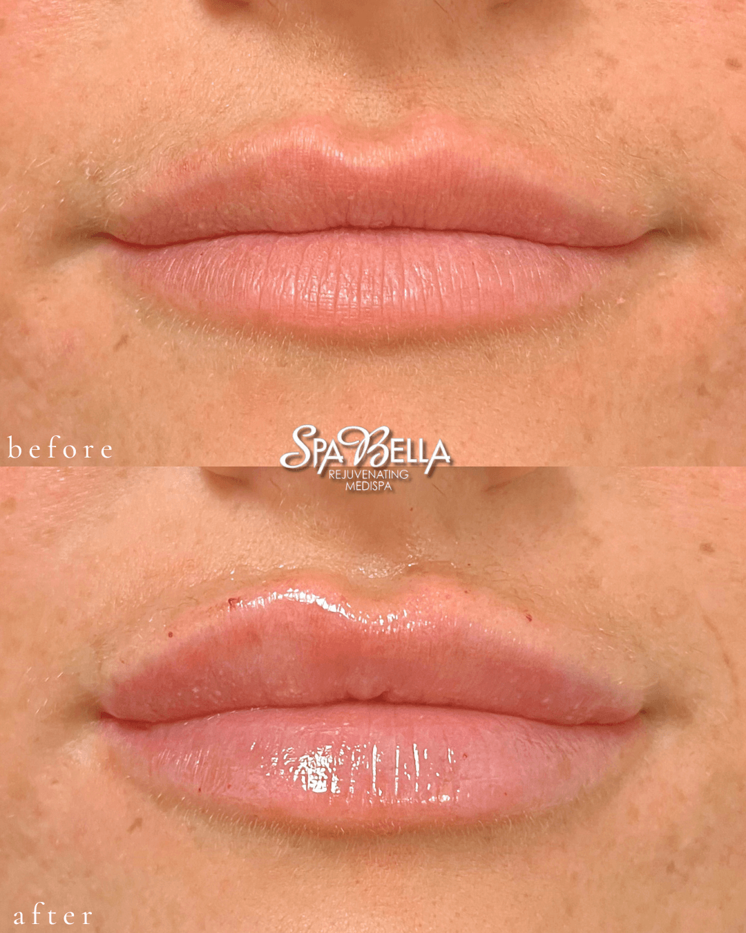 Lips - Before and After