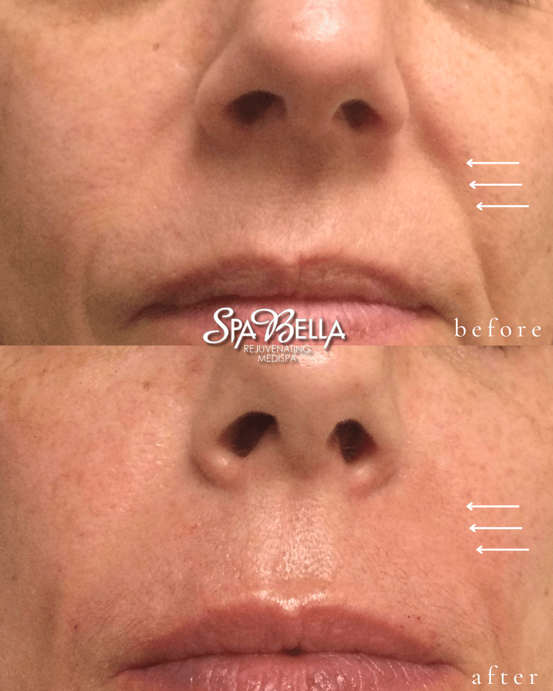 Vollure for Nasolabial Folds