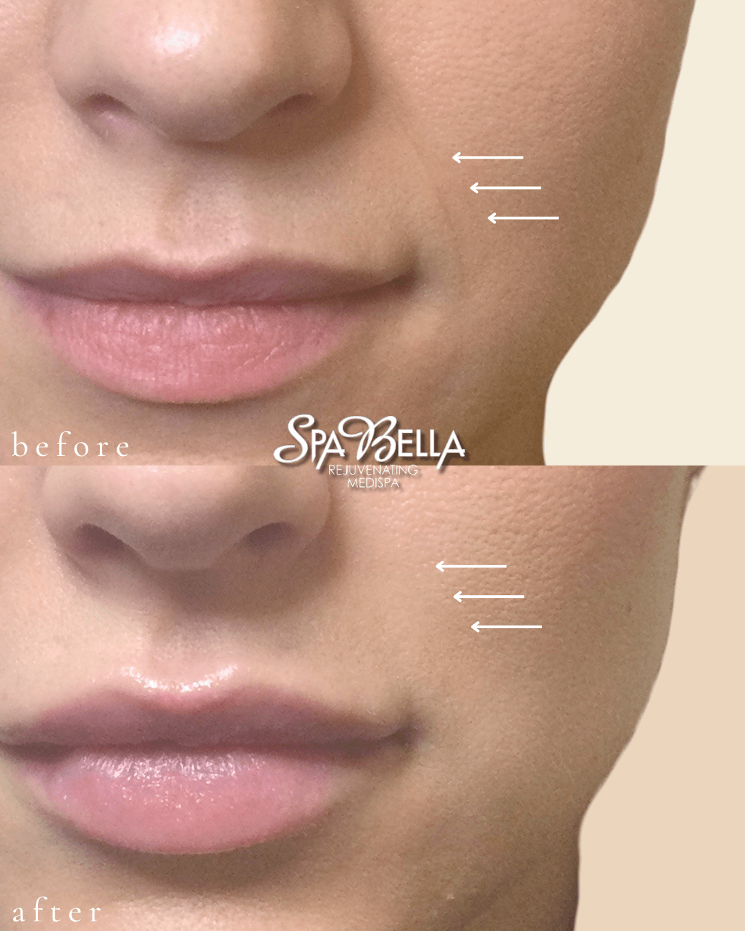 Nasolabial Folds - Before and After