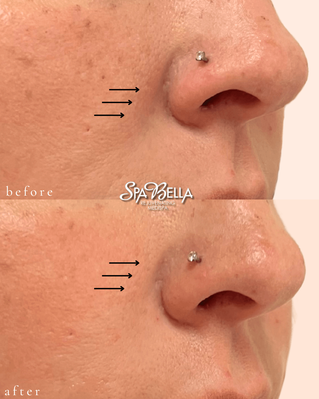 Nasolabial Folds - Before and After