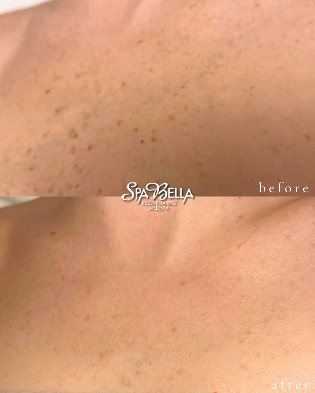 BBL/IPL - Before & After