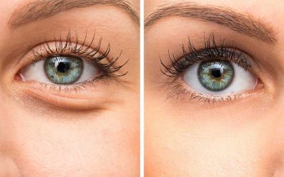 The Under-Eye Problem Nobody’s Talking About